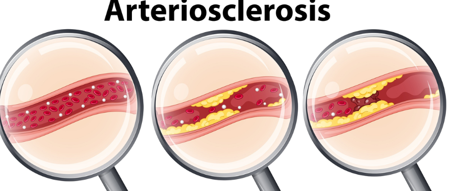 Arteriosclerosis Symptoms